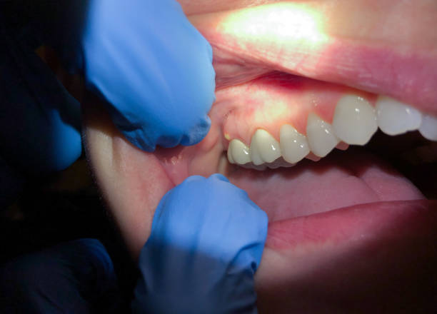 Best Emergency Treatment for Oral Infections in Marble Hill, MO